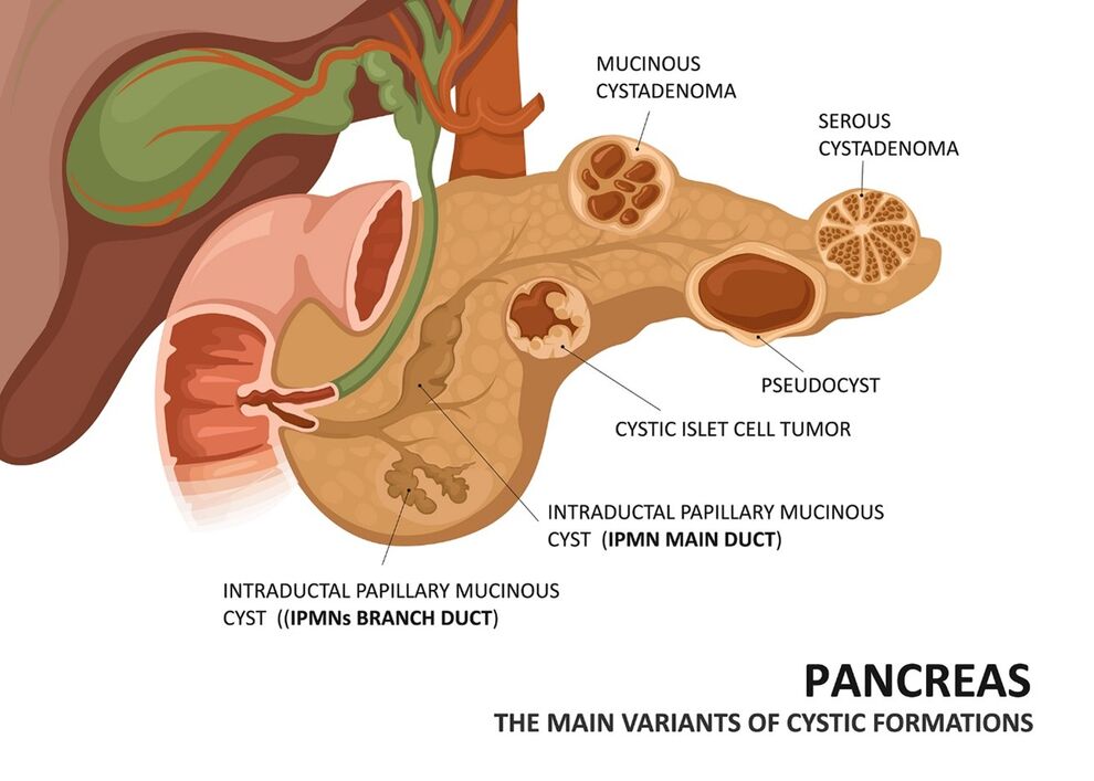 Abbildung: Schematische Darstellung der häufigsten zystischen Raumforderung des Pankreas. Quelle: nmfotograf_AdobeStock_542665335