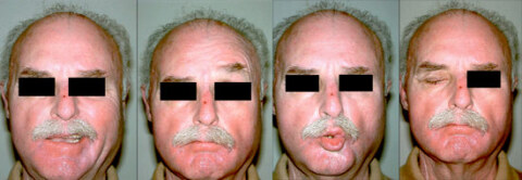 Patient ein Jahr nach Entfernung eines bösartigen Ohrspeicheldrüsentumors mit Gesichtsnervenlähmung rechts. Nervenrekonstruktion mit einer Hypoglossus-Fazialis-Jump-Nervenanastomose und einem Oberlidgewicht rechts.