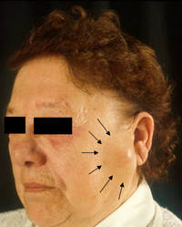 Ein Tumor der Ohrspeicheldrüse
fällt häufig erst durch die Schwellung
vor dem Ohr auf.