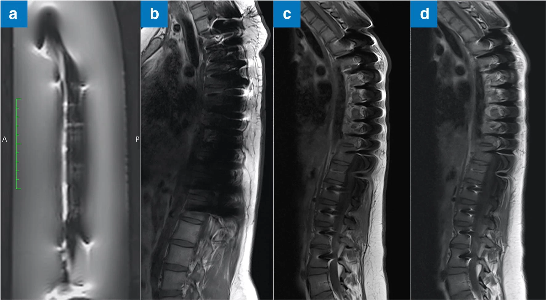 Heinrich, A. et al. MRI following scoliosis surgery? An analysis of implant heating, displacement, torque, and susceptibility artifacts. Eur Radiol 31, 4298–4307 (2021).