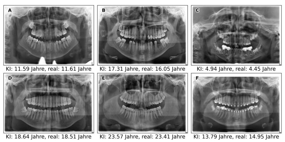 Koch, R. M., Mentzel, H.-J., Heinrich, A. Deep learning for forensic age estimation using orthopantomograms in children, adolescents, and young adults. European Radiology (2025).