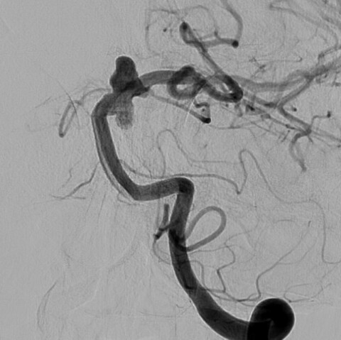 Komplexes Aneurysma des Basilariskopfes