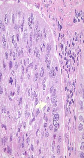 Tumortissue