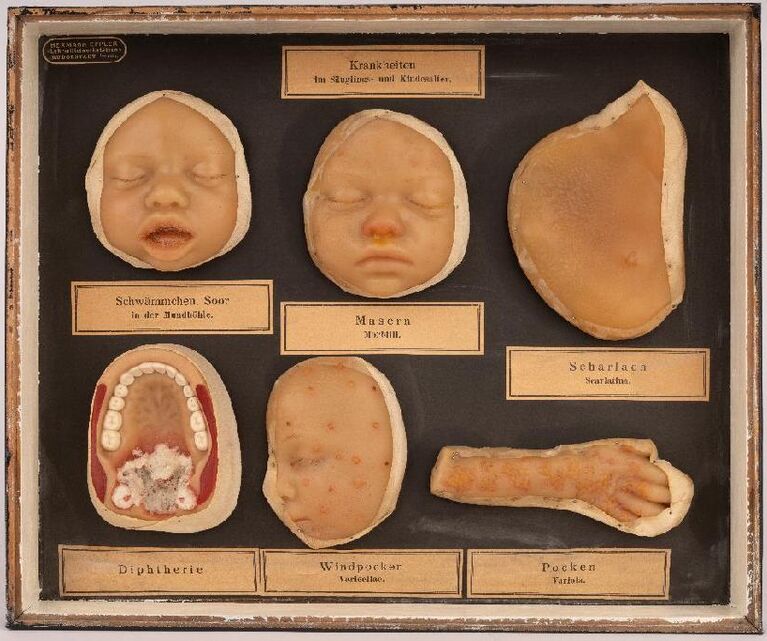Schenkung des Schiller-Gymnasiums Eisenberg: Moulagen von Kinderkrankheiten. Hermann Eppler Lehrmittelwerkstätten Rudolstadt, um 1930. Anatomische Sammlung Jena, Inv.Nr. UeM 007. (Foto: Marcus Rebhan)